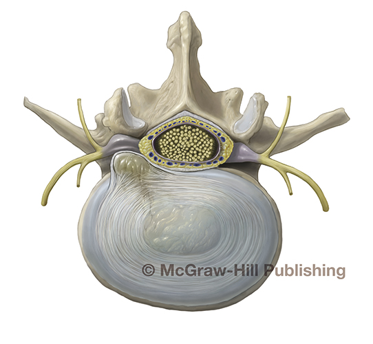 Medical Illustration of lumbar disc herniation